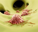 Meta analysis highlights prognostic role of circPVT1 in solid tumors