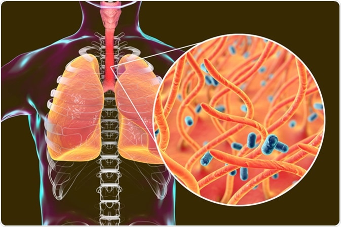 Whooping cough bacteria Bordetella pertussis in human airways, 3D illustration - Illustration Credit: Kateryna Kon / Shutterstock